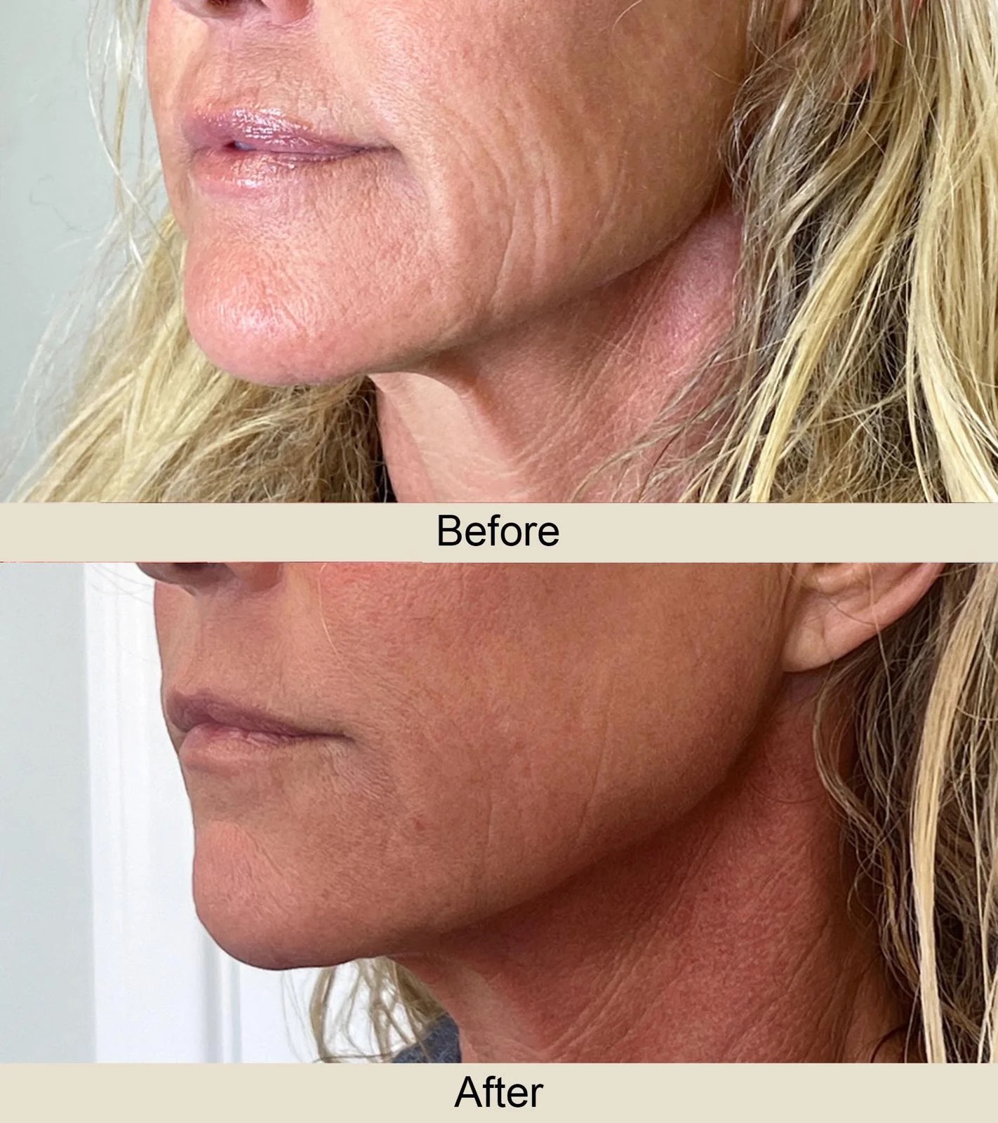 Before and after of jawline and neck lifted and tightened