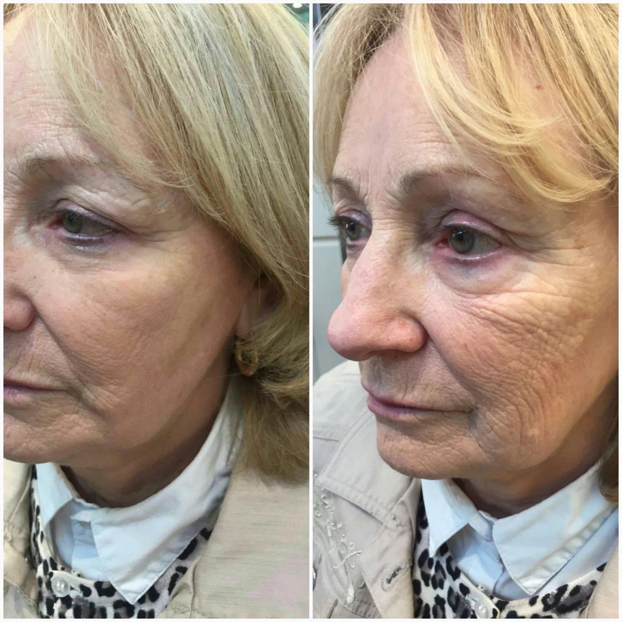 Before and after of overall facial skin rejuvenation